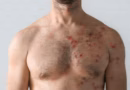Herpes zoster (šindre): uzroci, simptomi i kada potražiti savet lekara