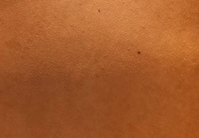Crveni ujedi u nizu: Da li su u pitanju stenice i kako ih prepoznati?