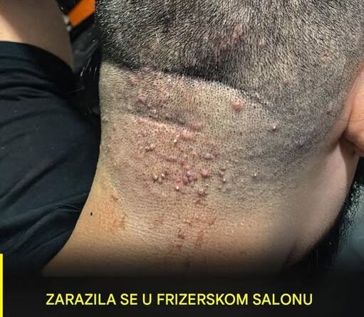Sitne kvržice nakon šišanja nisu uvijek bezazlene: Kako prepoznati folikulitis i spriječiti infekciju
