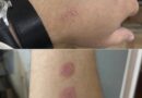 Kružne crvene promene na koži mogu ukazivati na infekciju, ali ne otkrivaju prevaru partnera