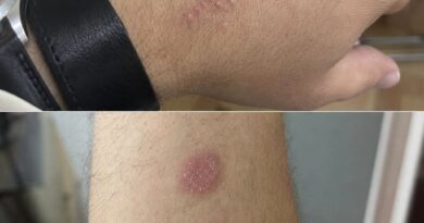 Kružne crvene promene na koži mogu ukazivati na infekciju, ali ne otkrivaju prevaru partnera Kružne crvene promene na koži mogu ukazivati na infekciju, ali ne otkrivaju prevaru partnera