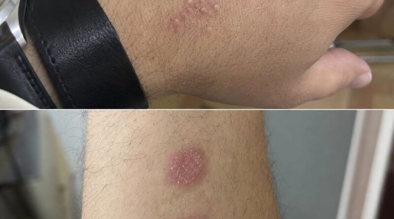 Kružne crvene promene na koži mogu ukazivati na infekciju, ali ne otkrivaju prevaru partnera Kružne crvene promene na koži mogu ukazivati na infekciju, ali ne otkrivaju prevaru partnera